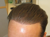 Exoderm Artificial Hair implant