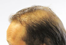 Exoderm Artificial hair implant Before