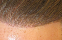  hair implant - Exoderm Medical Centers