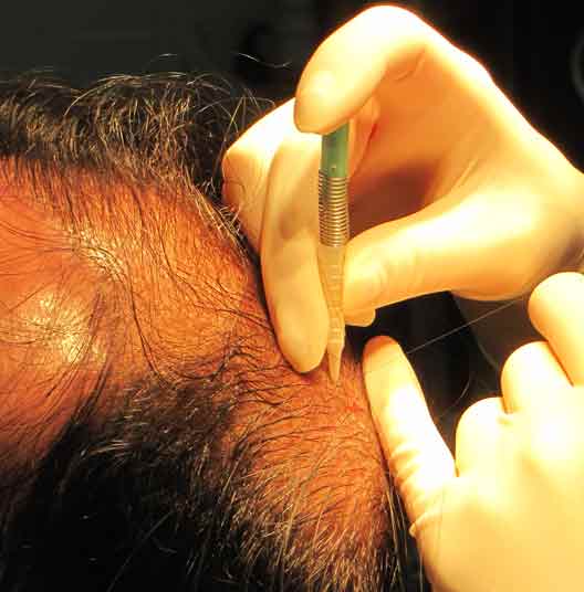 Exoderm I.M.C hair implant